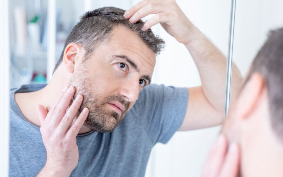 What can i do to treat Scalp Psoriasis?