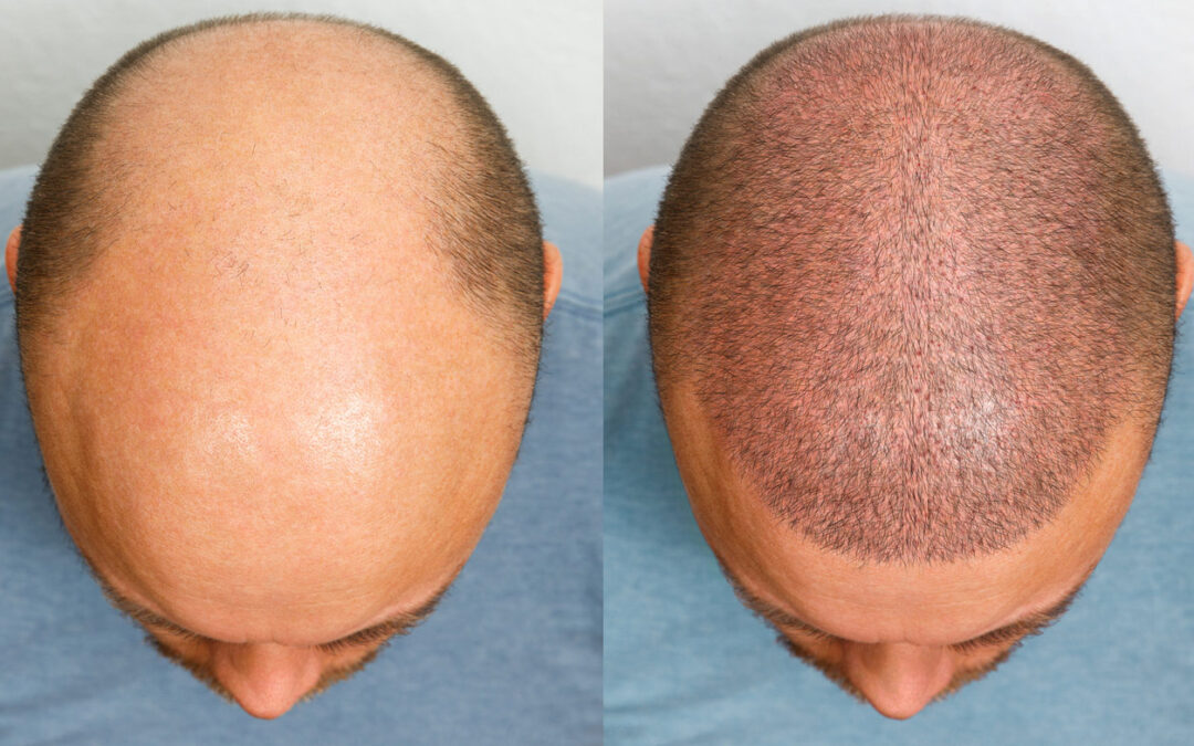 Hair Transplant: On Your Way to Looking Great