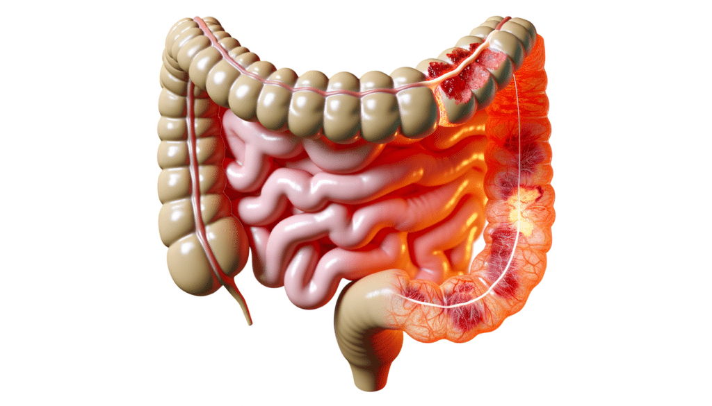 3D illustration of the human colon with inflamed areas highlighted in red.