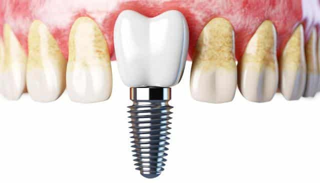 Close-up of teeth with two dental implants on the upper jaw.