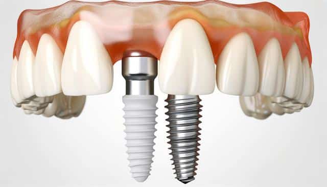 Illustration of dental implants in gums, showing two types of screw designs.