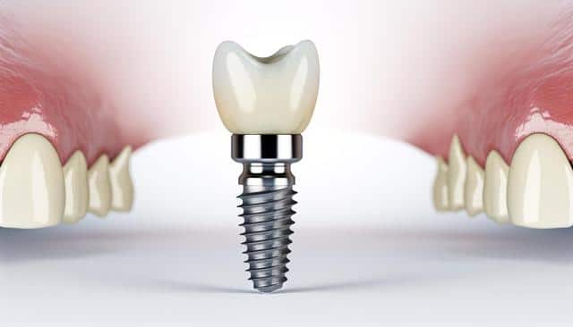 Dental implant illustration between gums and teeth.