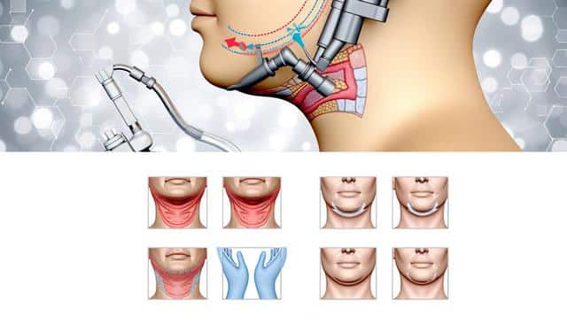 Illustration of a chin surgery procedure, with surgical tools and muscle diagrams.