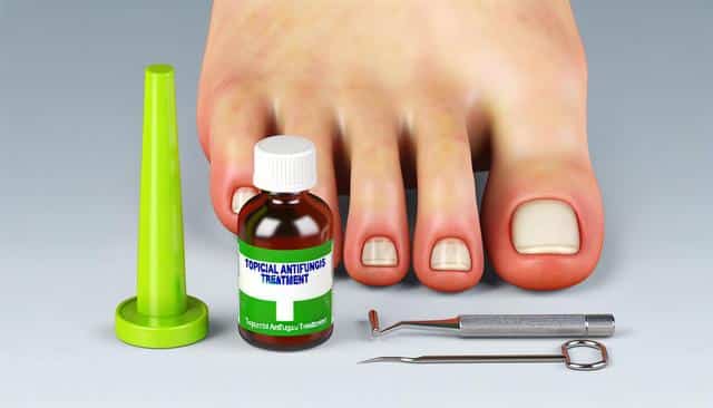 Foot with toenail fungus, antifungal treatment bottle, and nail tools.