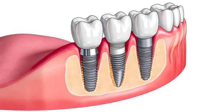 Illustration of dental implants in a section of human gums.