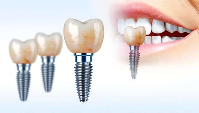 Illustration of dental implants with a close-up of them being placed near a set of teeth.