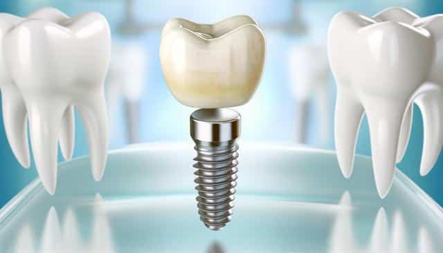 Illustration of a dental implant with a tooth crown on a blue background.