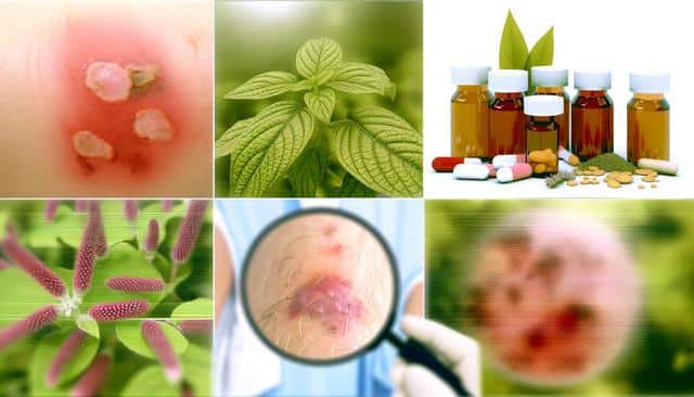 A six-part collage showing infected skin, leaves, medicine bottles, flowers, and a magnified view of a rash.