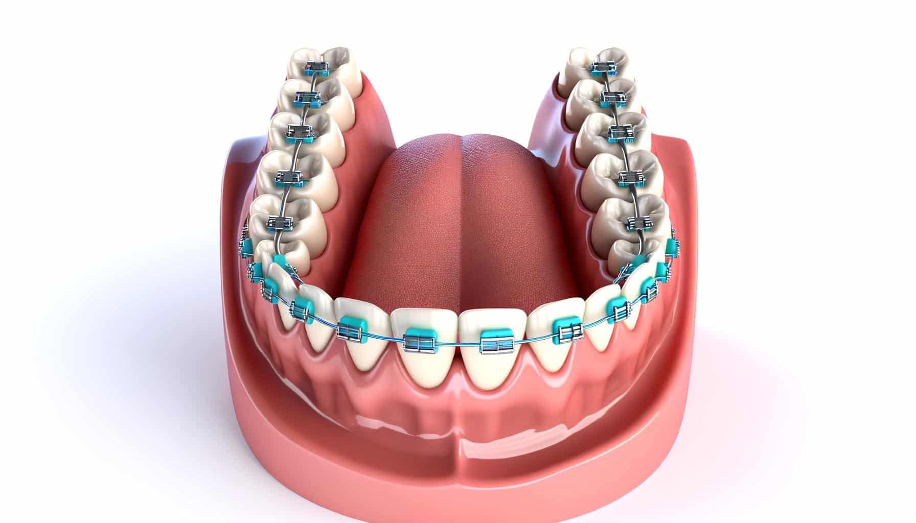 Illustration of teeth with braces on the upper jaw and visible tongue in a dental model.